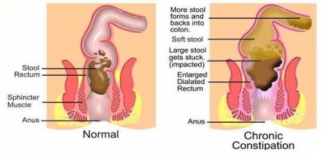 constipation and flaxseed, flaxseed for constipation, flax for constipation, constipation and flaxseed meal