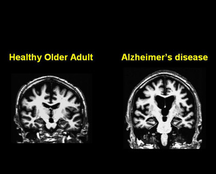 nutrition and brain, flaxseed brain